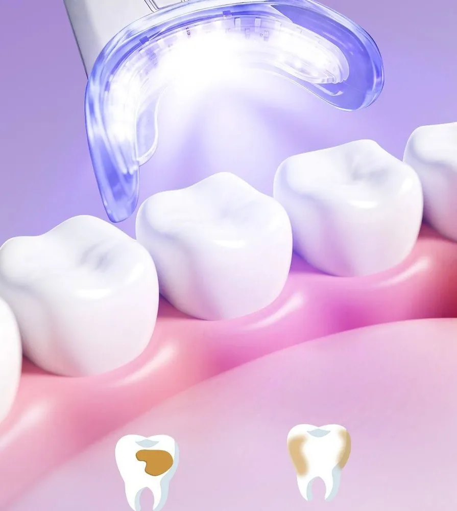 Kit de blanchiment des dents Boldsmile : appareil à LED et stylos blanchissants, 6 ou 9 stylos – Image 6